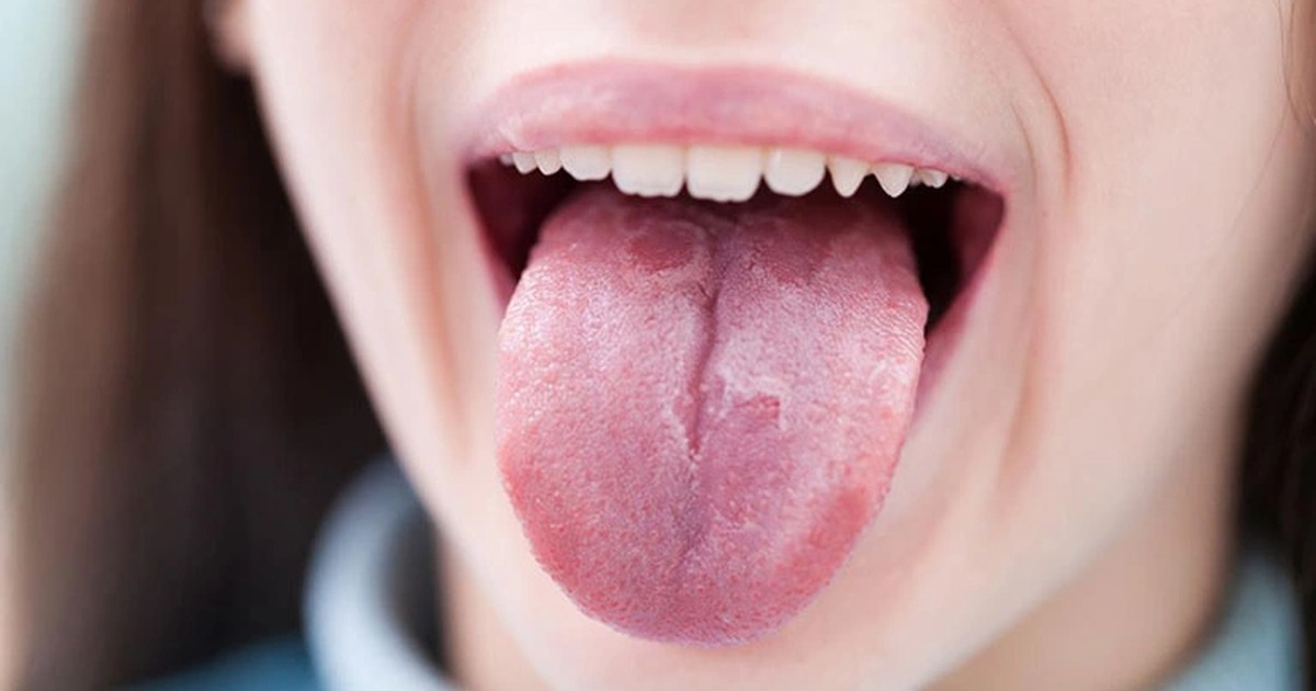 Triệu chứng ung thư lưỡi: Dấu hiệu nhận biết sớm và cần lưu ý