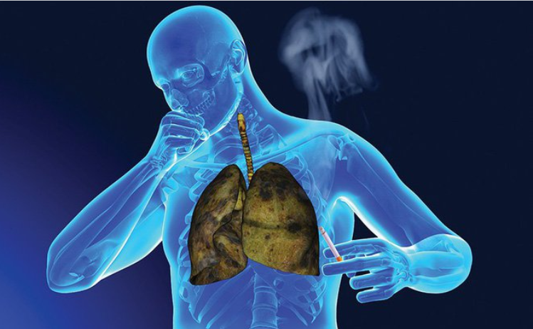 Cây thuốc nam trị ung thư phổi có hiệu quả không?