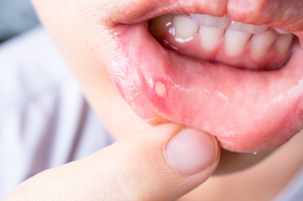 Cách phân biệt ung thư lưỡi với nhiệt miệng để phát hiện sớm