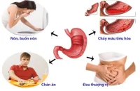 Bệnh đau dạ dày và cách điều trị từ nano curcumin dạ dày