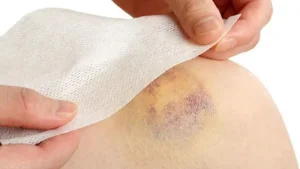 Ung thư m&aacute;u khiến hệ miễn dịch bị suy giảm nghi&ecirc;m trọng